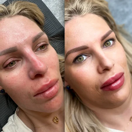 lip cosmetic tattoo