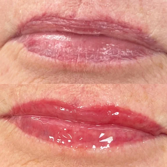 lip liner cosmetic tattoo