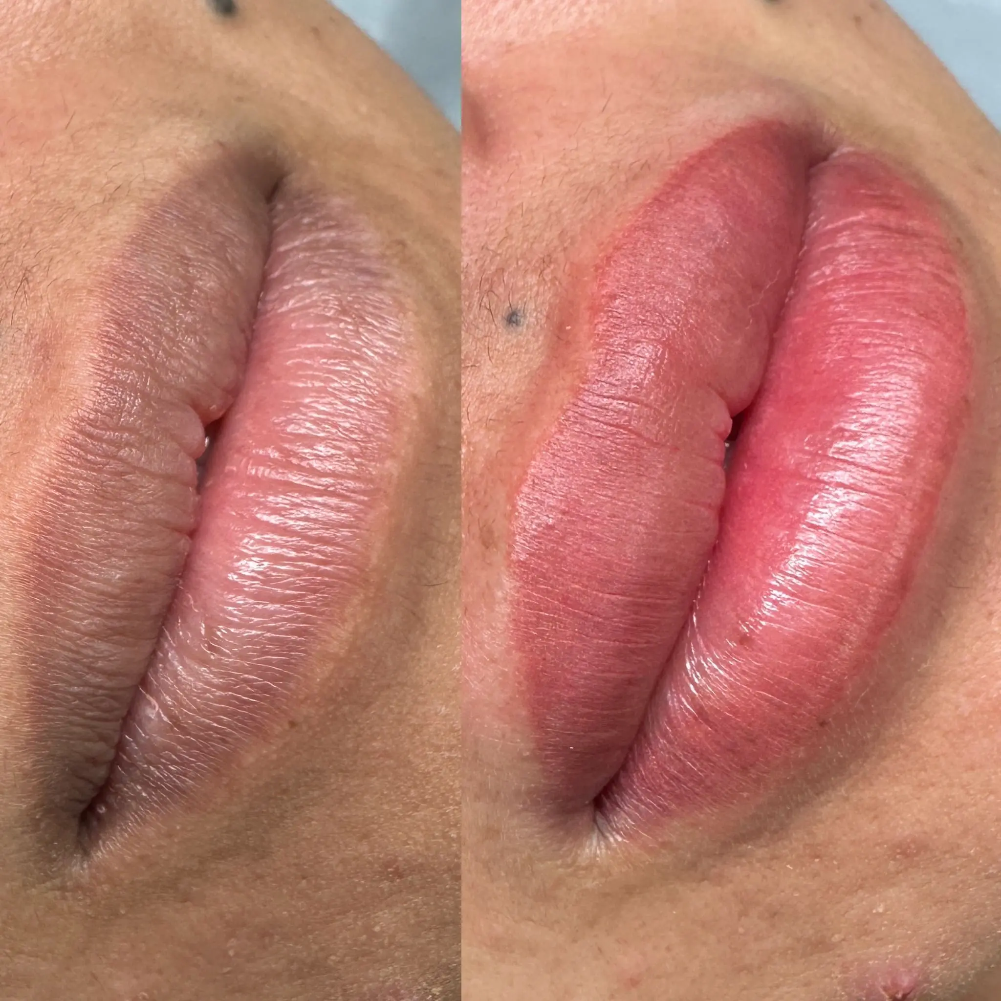 dark lip correction melbourne