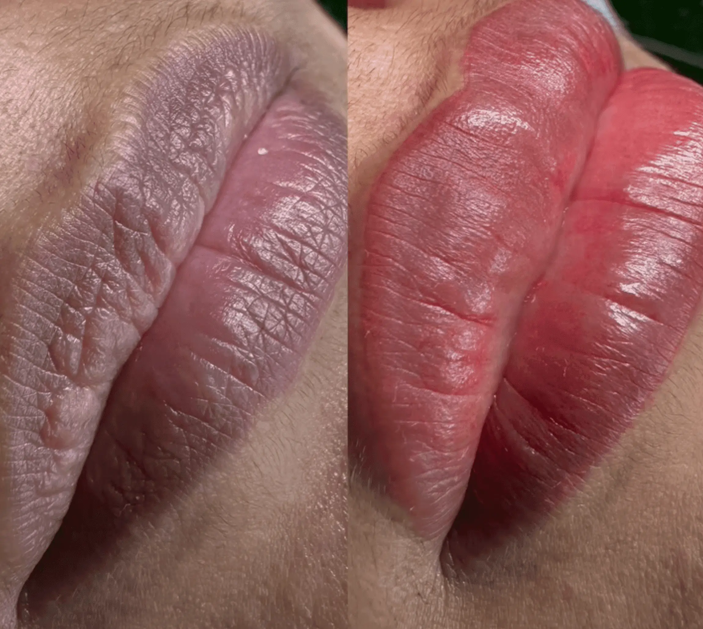 dark lip correction melbourne