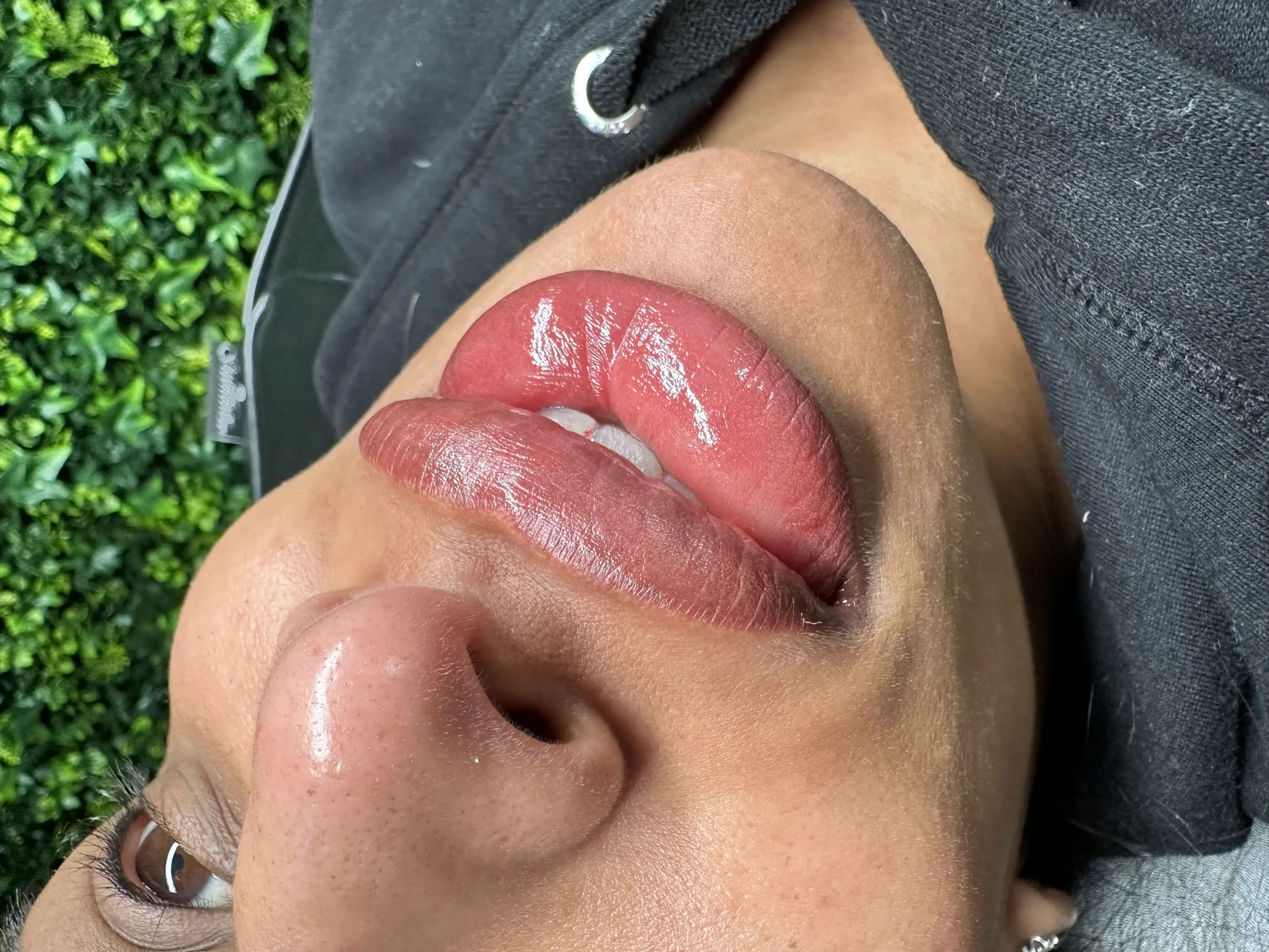 lip neutralization melbourne