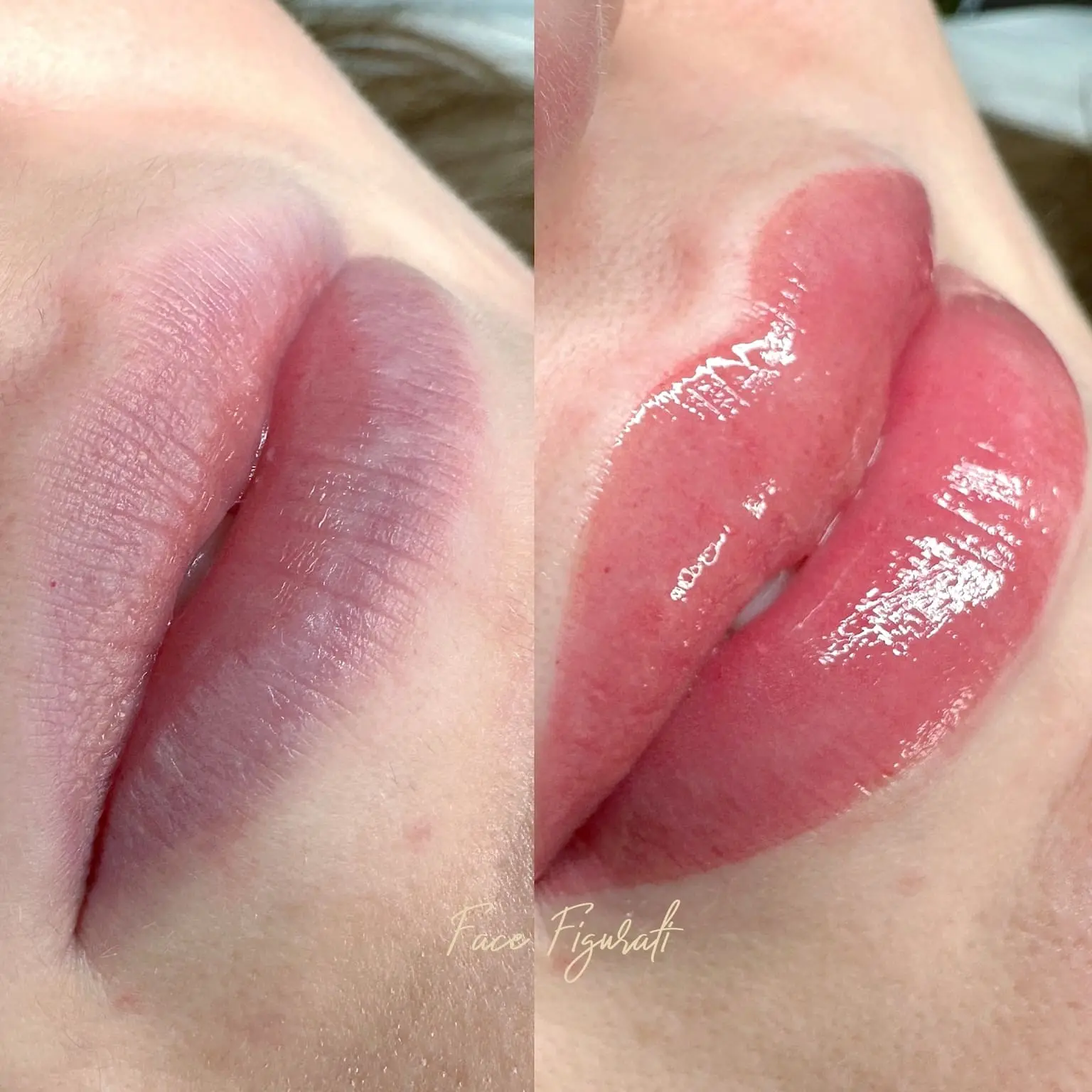 lip neutralization near me